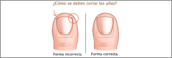 corte adecuado de uñas